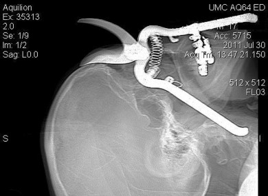 The X-ray of Mr Luetscher's head after he fell on the shears