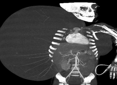 An image created through medical imaging technology shows an X-ray-like image of 2-year-old Jesus Rodriguez, prior to having a benign tumour removed from his body.