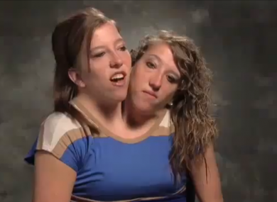 Siamese twins pictures video #2