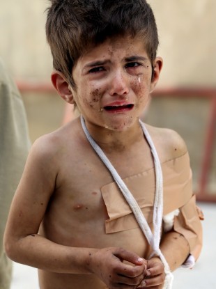 A Syrian girl, Bushra al-Hassan, 4, injured from a government airstrike.