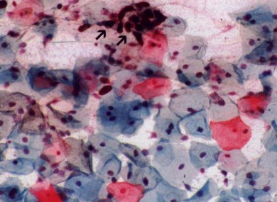 Cervical smear results