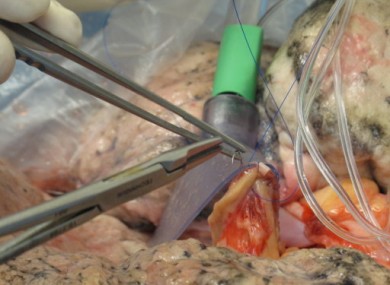 An atrial cuff into a set of human lungs to check their suitability for transplant.