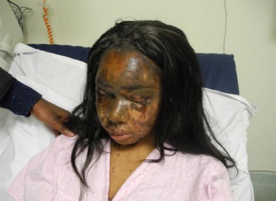 Naomi Oni after she had acid thrown in her face by Mary Konye.