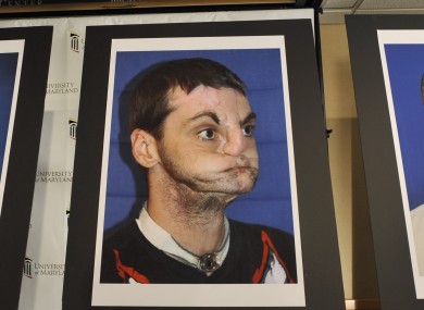 Richard Norris before his face transplant. The quote in the headline comes from Randy James, who was born with Goldenhar Syndrome.