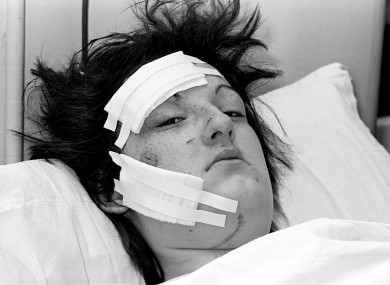 Barbara Lane, 21, one of the victims of the bomb attack on the Tavern in the Town pub in hospital in 1974.