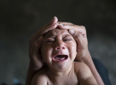 A child born with Microcephaly in Brazil pictured last month