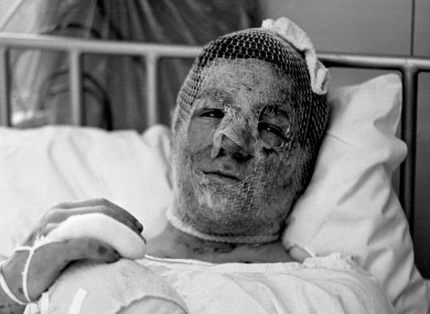 Gary Cowan, 16,in a Birmingham hospital following the 1974 bomb attack on the Tavern in the Town pub.