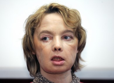 Isabelle Dinoire, the woman who received the world's first partial face transplant