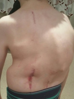 The worsening curve in the back of Tommy Long, from Kilkenny, currently awaiting an appointment to reinsert a rod in his back.