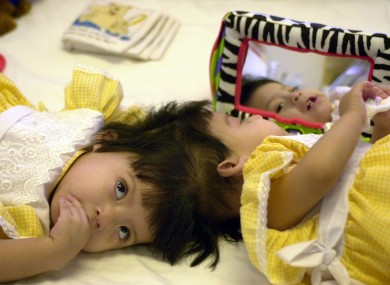The twins in 2002, before their operation.