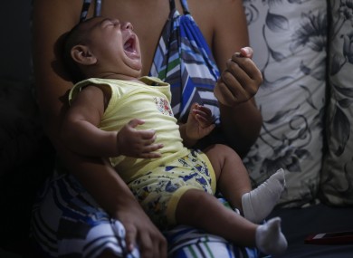 A baby born with microcephaly - which scientists say is caused by the mosquito-transmitted Zika virus.