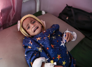 A malnourished child lies in a bed at a therapeutic feeding centre in a hospital in Sanaa, Yemen