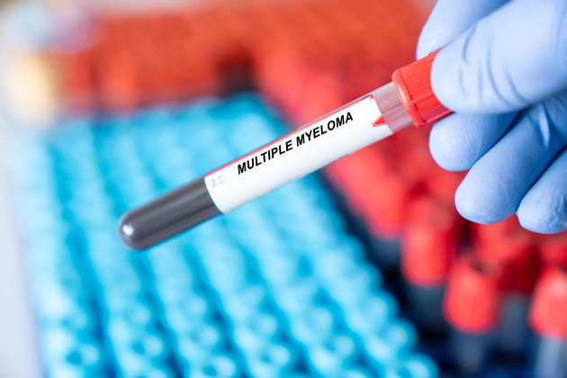 Living with myeloma: 'I chose not to fight this blood cancer, but to instead live alongside it'